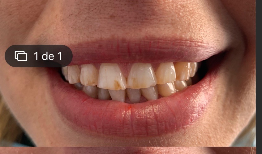 Antes - Maquillaje con Resinas