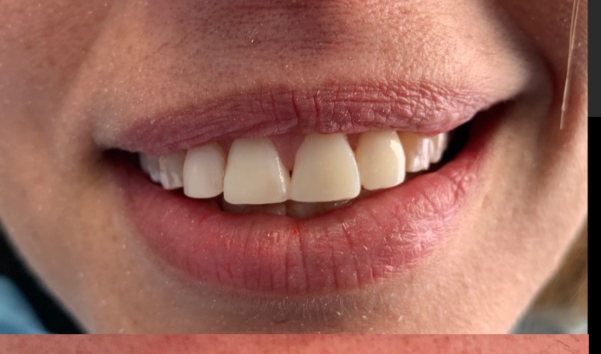 Después - Maquillaje con Resinas