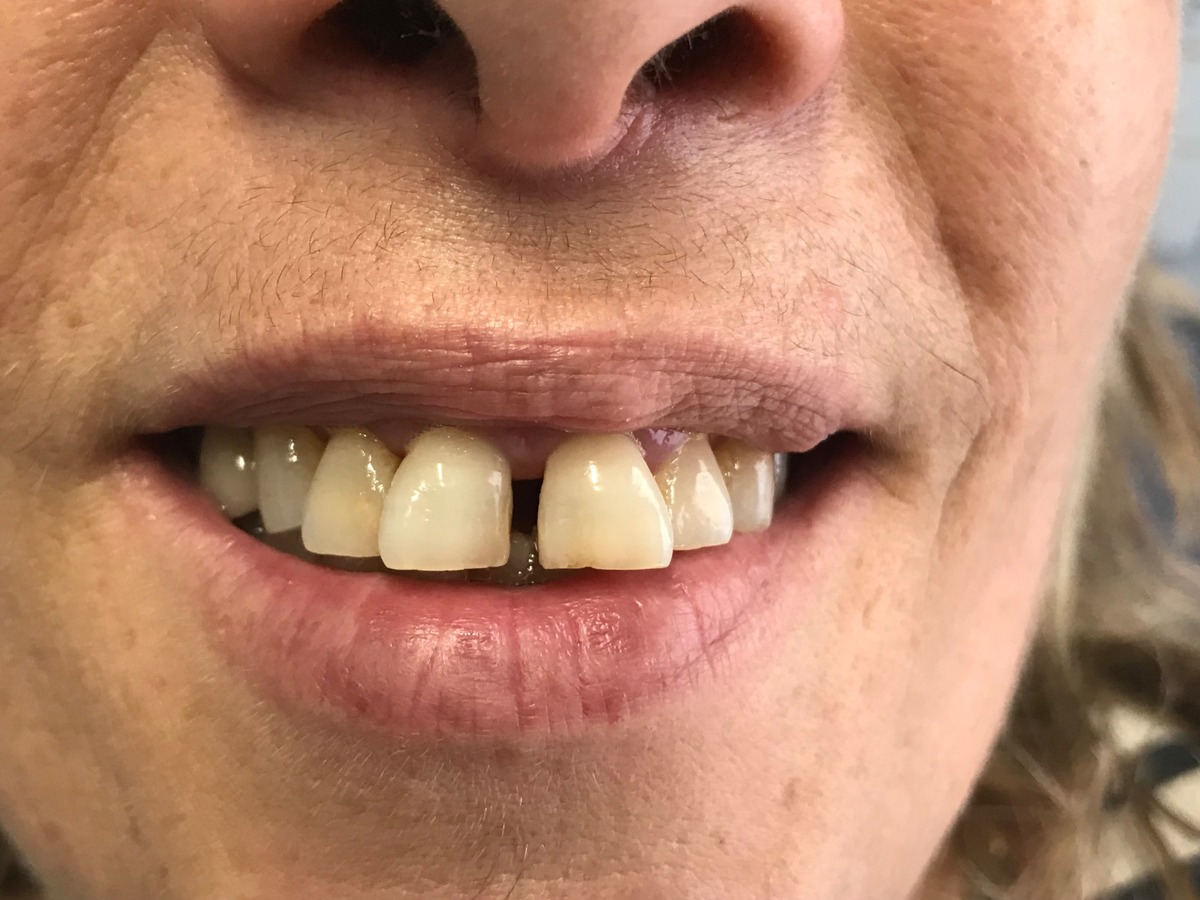Antes - Cierre de Diastema con Composite