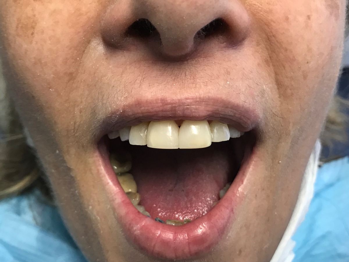 Después - Cierre de Diastema con Composite