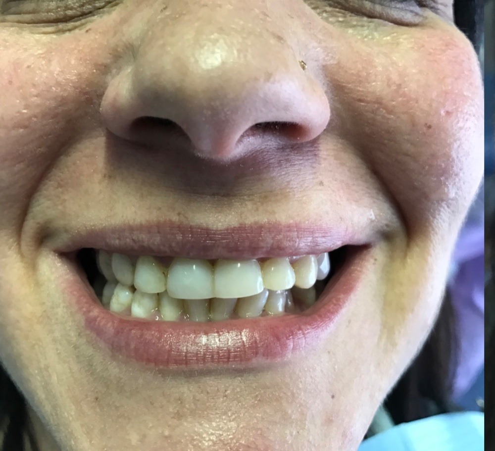 Antes - Diseño de Sonrisa con Resinas