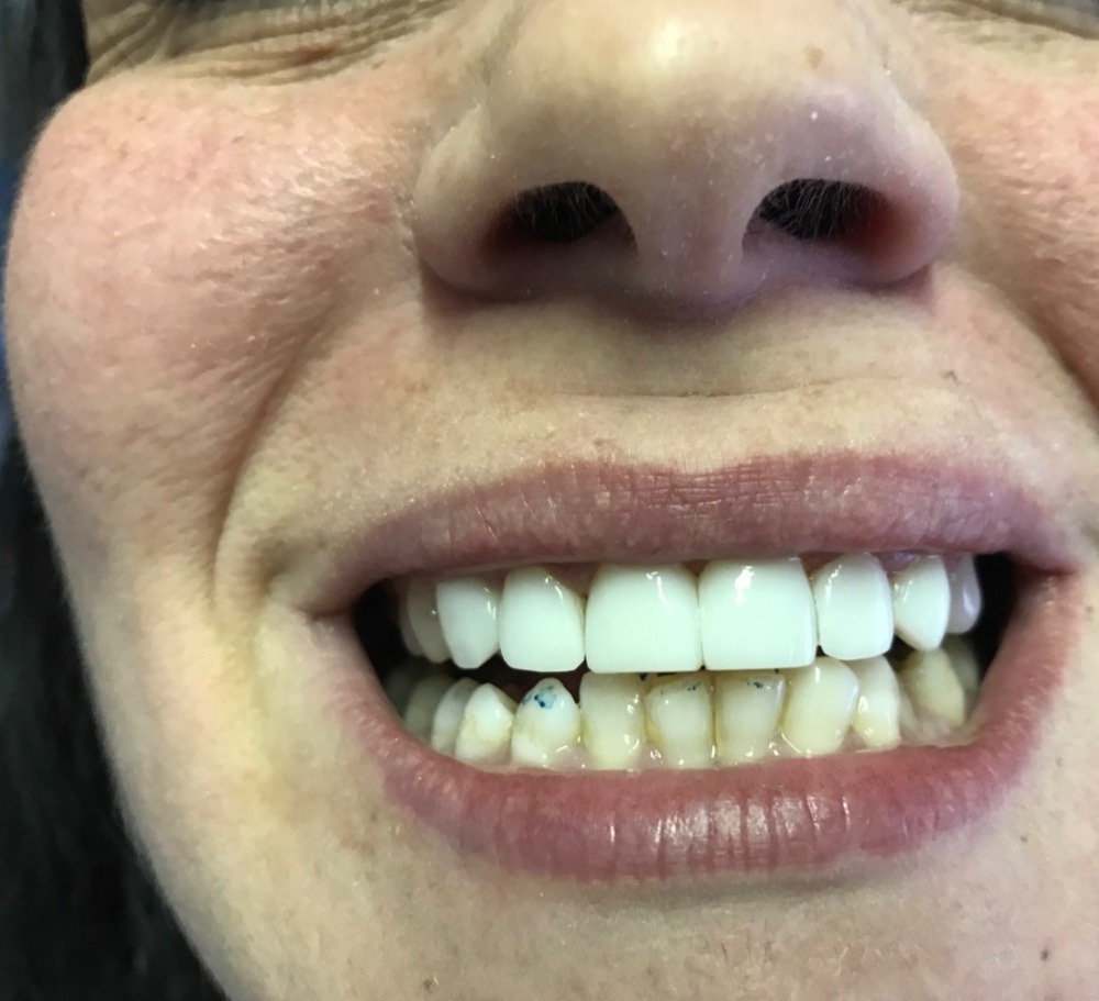 Después - Diseño de Sonrisa con Resinas