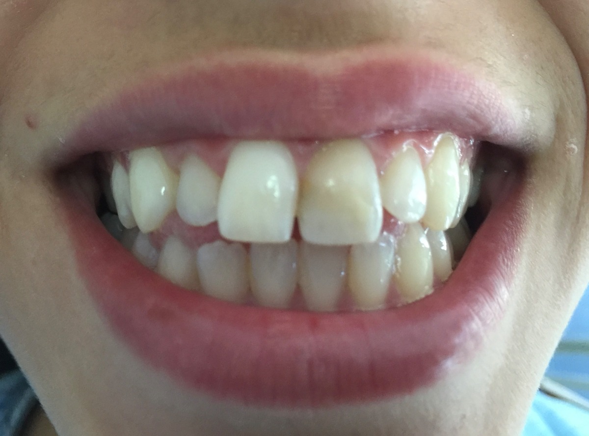 Antes - Estética Anterior con Composite
