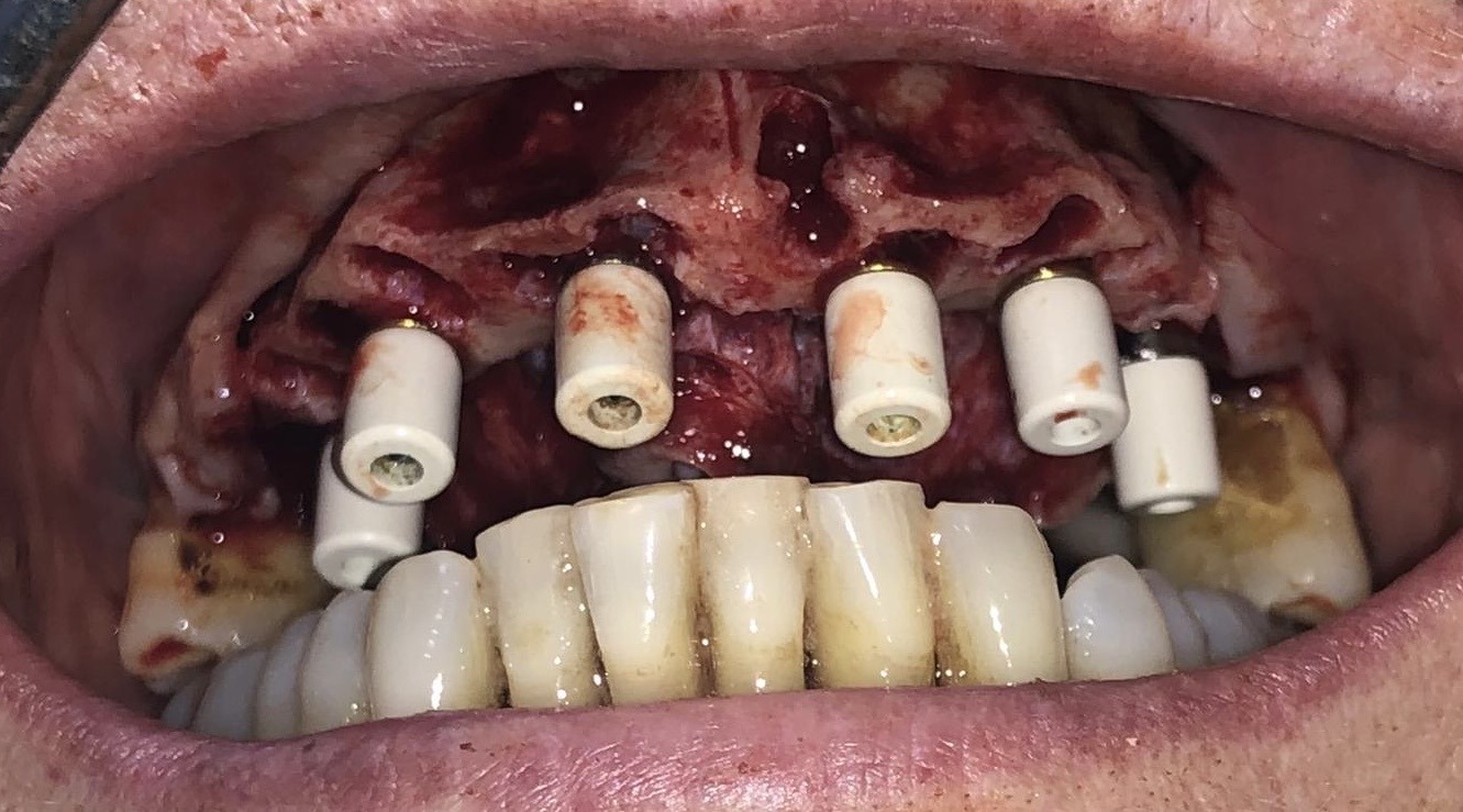 Escáner 3D con implantes
