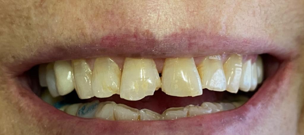 Antes - Rehabilitación Estética