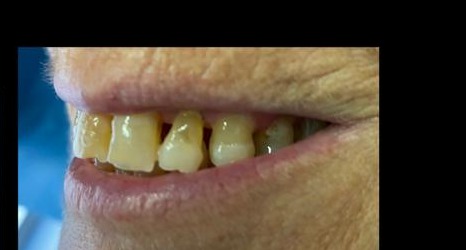 Antes lateral