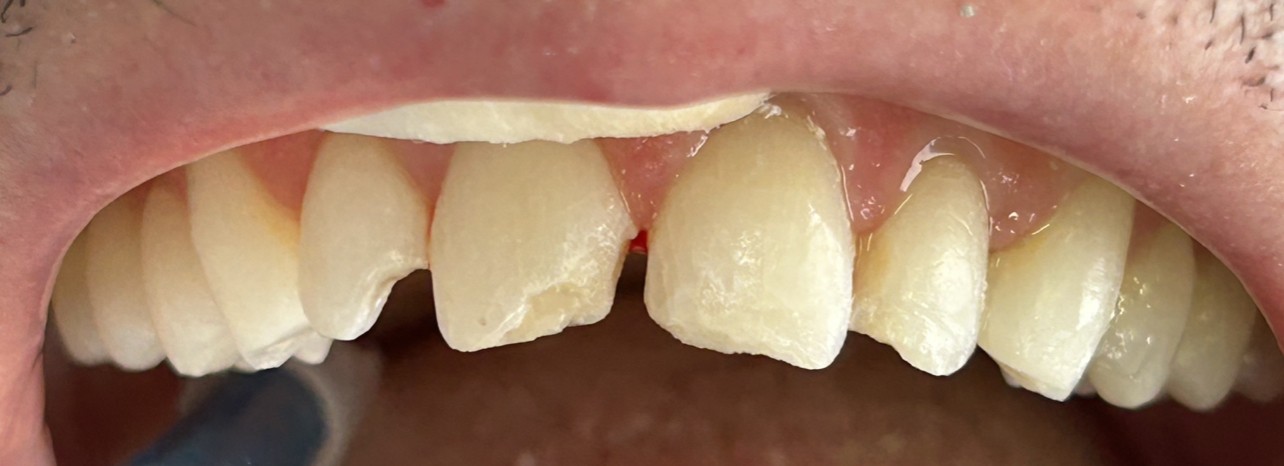 Antes - Traumatismo dental