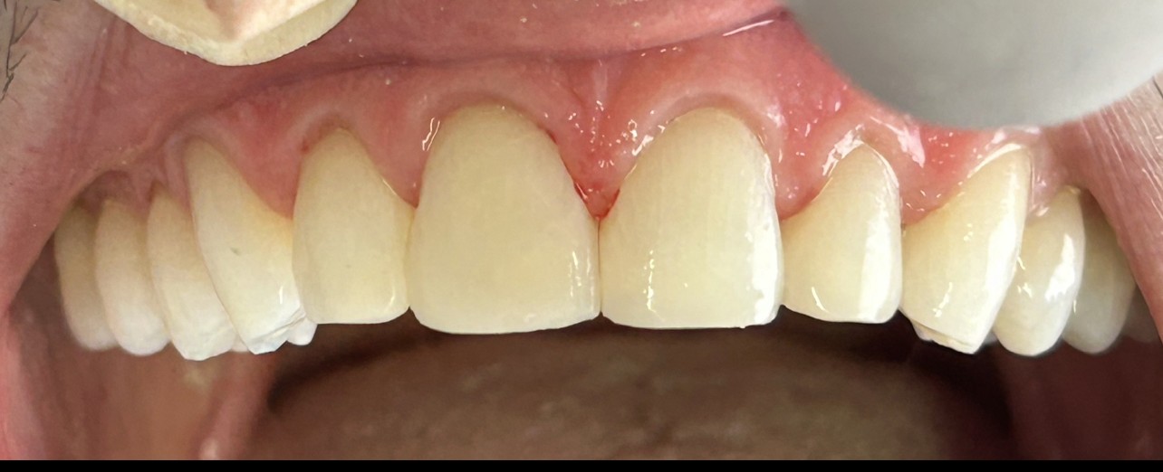Después - Traumatismo dental